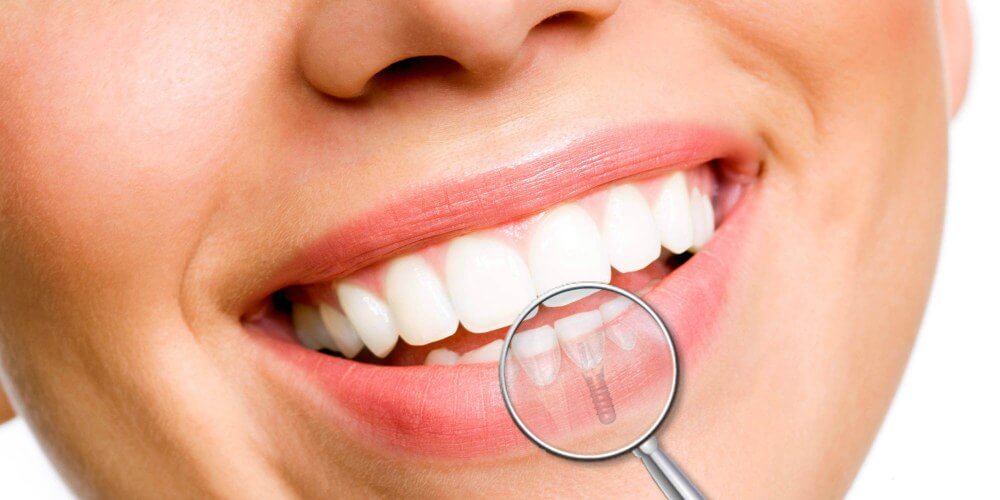 implantologia-dental-blog