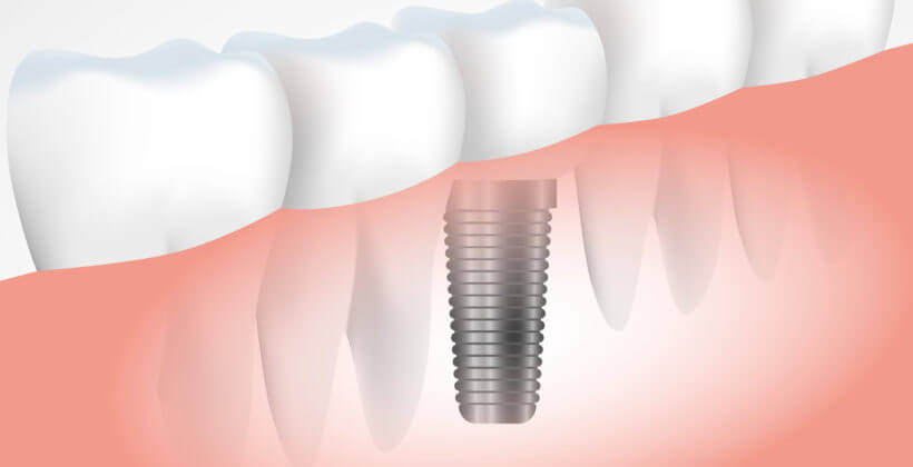 Todo lo que debes saber sobre implante dental
