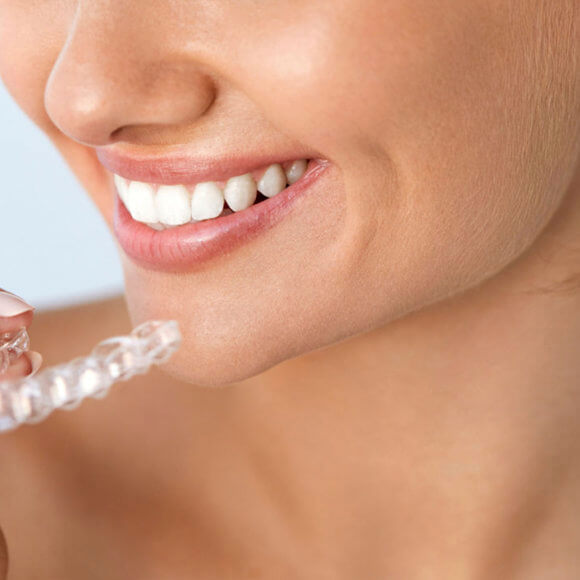 4 Ventajas de la ortodoncia invisible