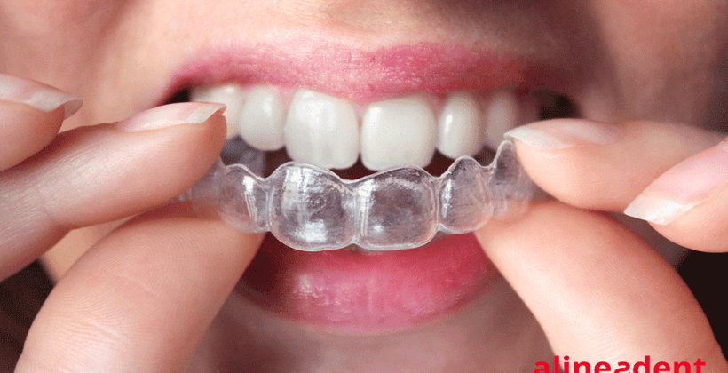 Alineación dental: métodos más eficaces